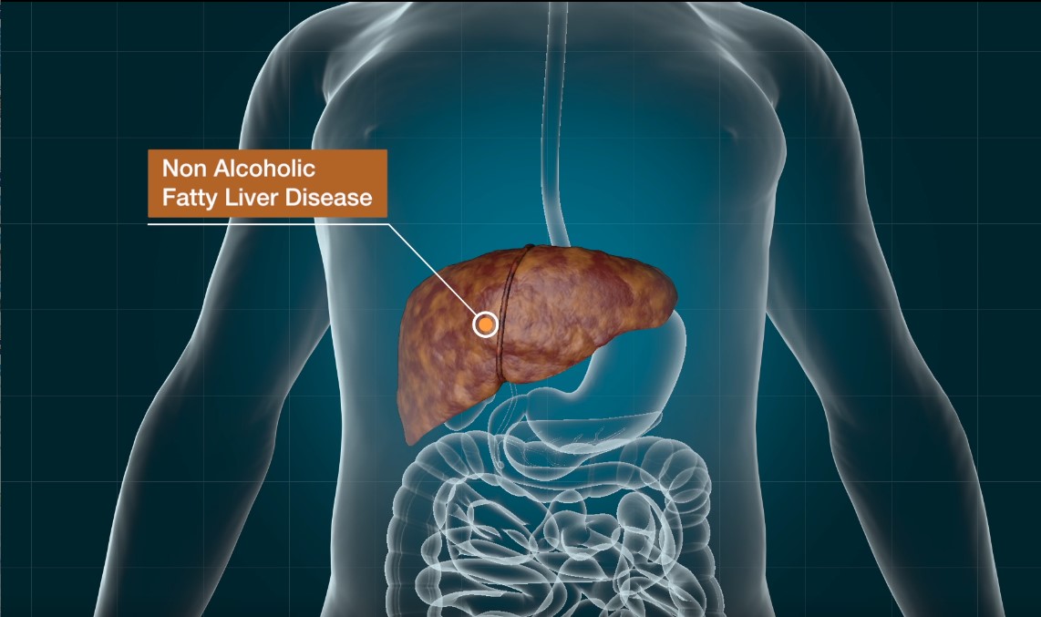 Modified Parkinson’s Drug Shows Potential in Treating Nonalcoholic Fatty Liver Disease 이미지