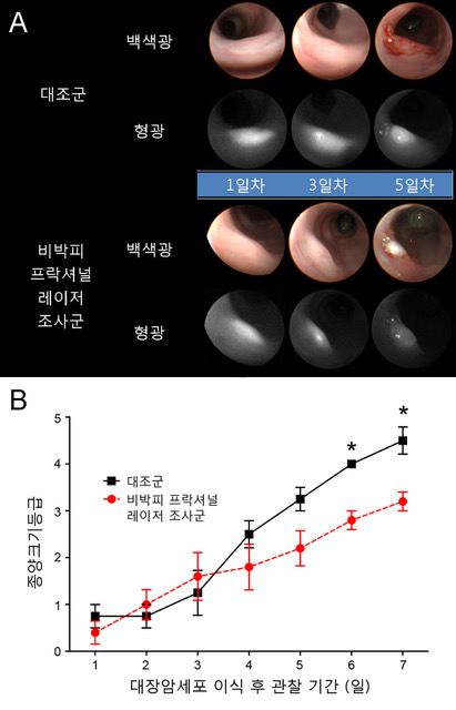 정의헌 교수팀, 비박피성 프락셔널 레이저를 이용한 조기 대장암의 내시경 치료법 개발 이미지