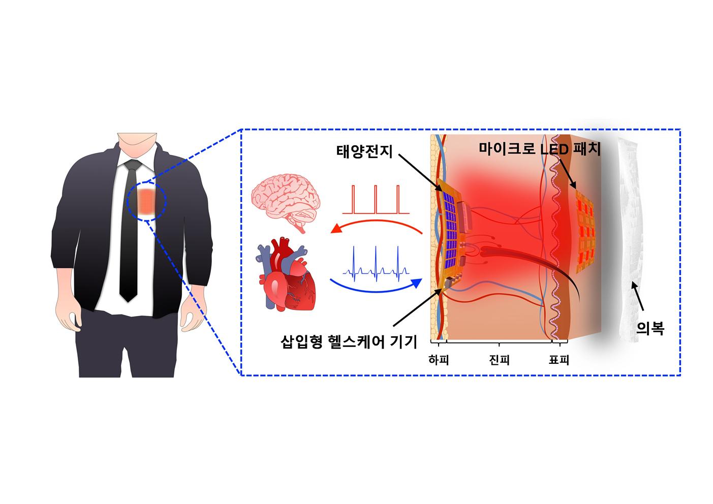 이종호 교수 연구팀, 몸 안에 전력을 공급할 수 있는 피부형 마이크로 LED 패치 개발 이미지