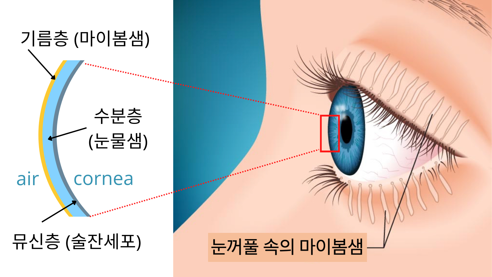 정의헌 교수 공동연구팀, 눈꺼풀 마이봄샘 소실을 인공지능으로 판독한다 ! 이미지